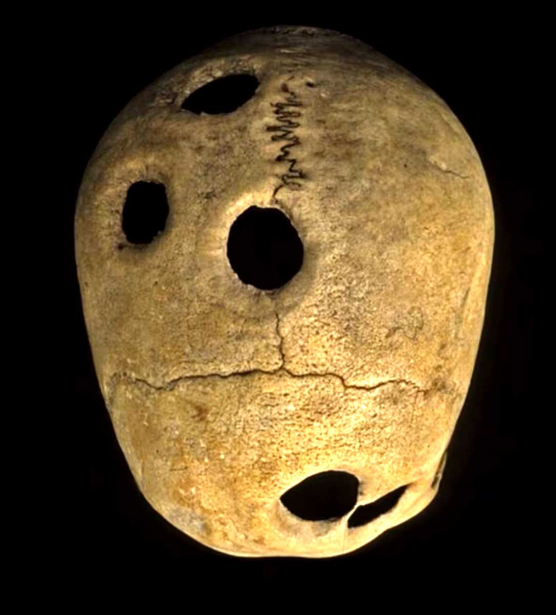 inca skull five holes trepanation